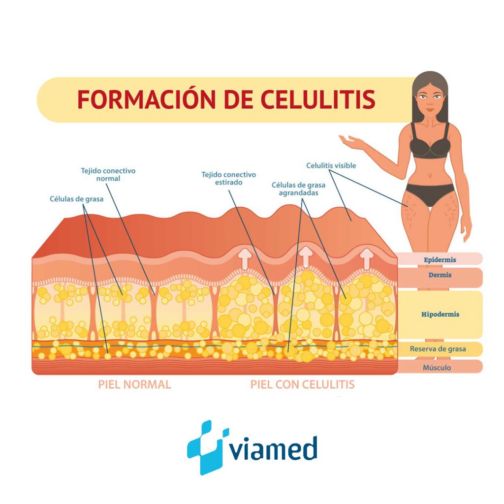 Celulitis, algo más que un problema estético