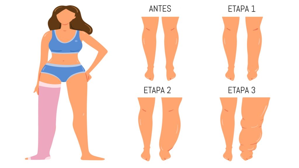 El Linfedema: La enfermedad oculta, que afecta a 1.600.00 personas en España