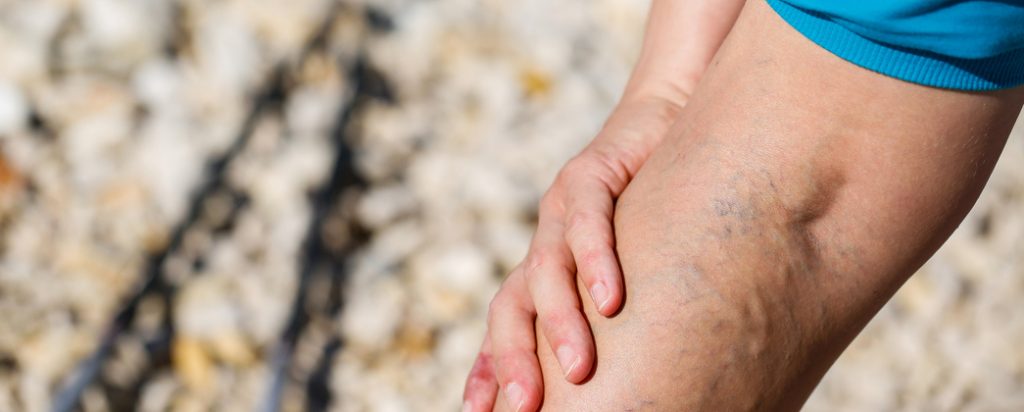 Sufres varices, ¿sabes cómo tratarlas?