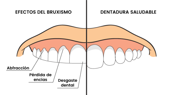 Bruxismo dental: causas, síntomas y tratamiento