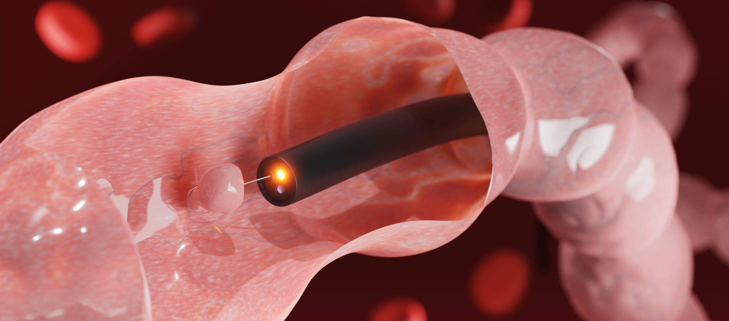 Colonoscopia con Sedación