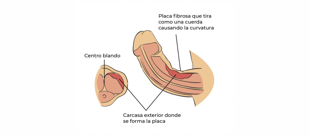 ¿Qué es la curvatura del pene o pene curvo?