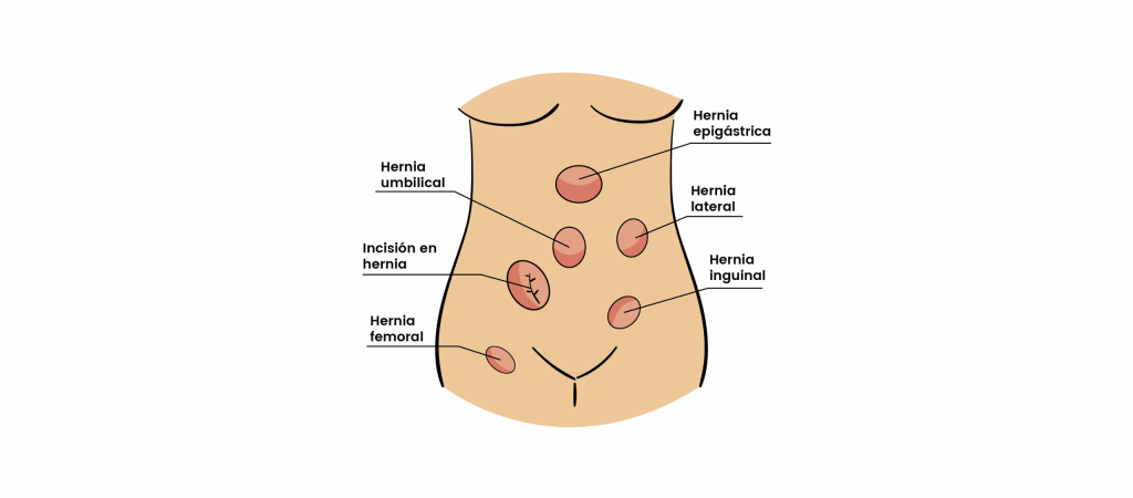 Operación Hernia Umbilical