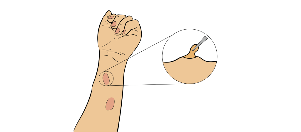 Extirpación de los Quistes Sebáceos y Lipomas infectados