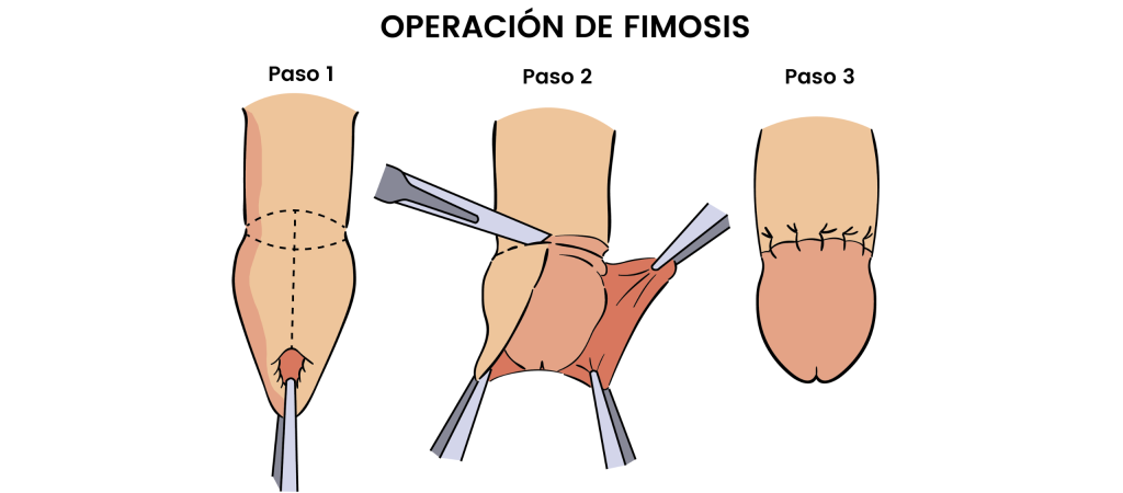 Operación de Fimosis, Frenillo o Circuncisión