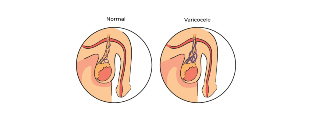 Operación de Varicocele