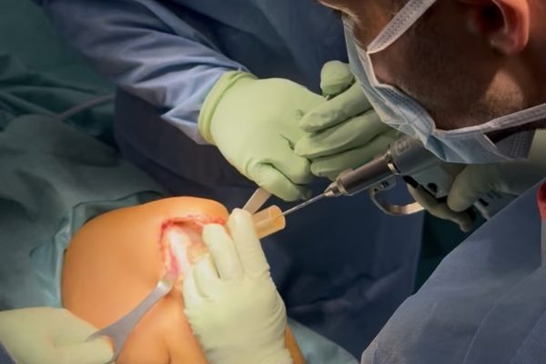 El Hospital Viamed Los Manzanos realiza por primera vez un trasplante osteocondral con tejido fresco como alternativa a la prótesis de rodilla en una paciente joven